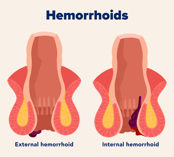 Understanding the Different Types of Hemorrhoid Treatments: Pros and Cons