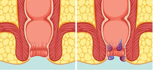 Piles vs. Other Anal Conditions: How to Distinguish Symptoms