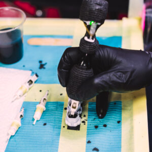 Laser tattoo removal treatment using advanced laser technology
