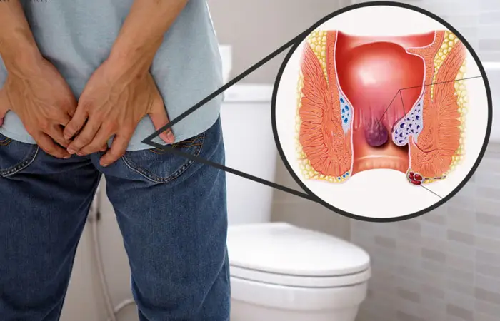 When are Piles a Sign of Something More Serious? Understanding Complications